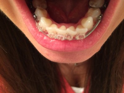 Niềng răng ở tuổi 28