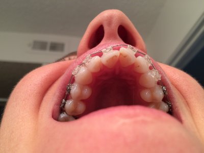 Niềng răng ở tuổi 28