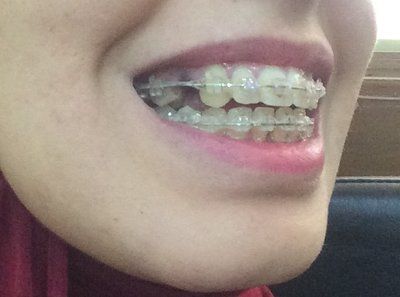 27 tuổi- niềng răng mắc cài trong suốt để khắc phục hô vẩu