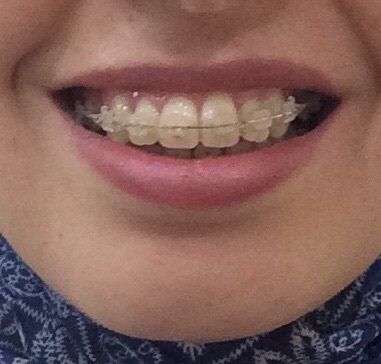 27 tuổi- niềng răng mắc cài trong suốt để khắc phục hô vẩu