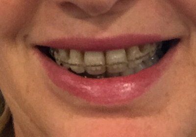 Niềng răng ở tuổi 50