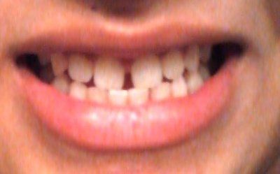 Kết quả niềng răng six month smile mang lại cho mình