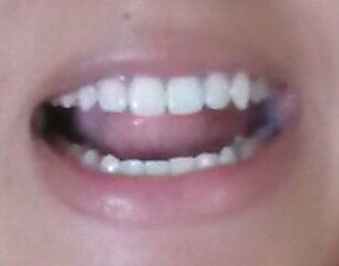 Kết quả niềng răng six month smile mang lại cho mình