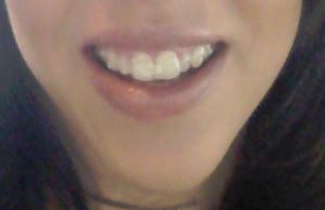 Trải nghiệm niềng răng Invisalign lần đầu