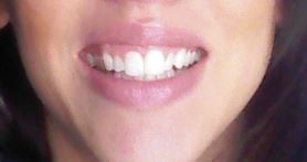 Trải nghiệm niềng răng Invisalign lần đầu