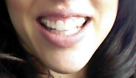 Trải nghiệm niềng răng Invisalign lần đầu