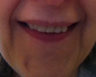 Niềng răng Invisalign ở tuổi 57