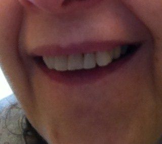 Niềng răng Invisalign ở tuổi 57