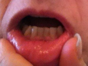 Niềng răng Invisalign ở tuổi 57