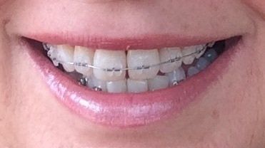 Niềng răng ở tuổi 50