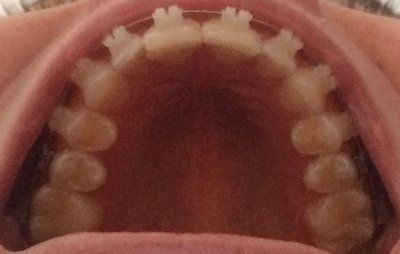 Hành trình niềng răng ở tuổi 22