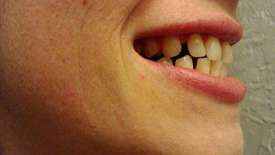 Niềng răng để khắc phục răng thưa