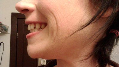 Niềng răng để khắc phục răng thưa