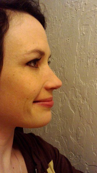 Niềng răng để khắc phục răng thưa