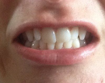 Niềng răng truyền thống để chữa răng khấp khểnh và một số tip