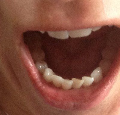 Niềng răng truyền thống để chữa răng khấp khểnh và một số tip