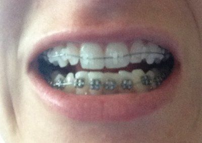 Niềng răng truyền thống để chữa răng khấp khểnh và một số tip