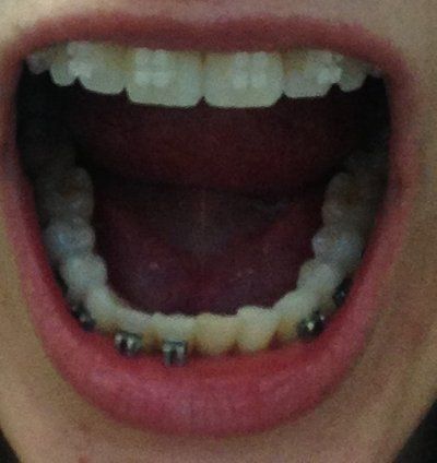 Niềng răng truyền thống để chữa răng khấp khểnh và một số tip