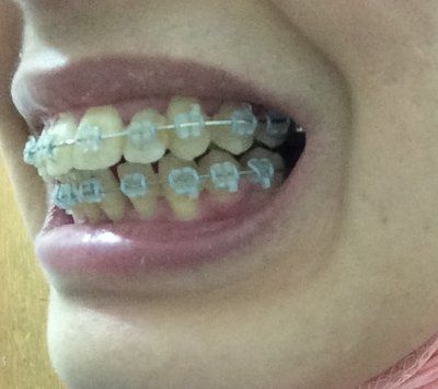 27 tuổi- niềng răng mắc cài trong suốt để khắc phục hô vẩu