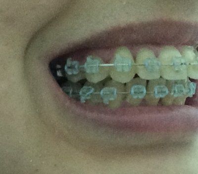 27 tuổi- niềng răng mắc cài trong suốt để khắc phục hô vẩu
