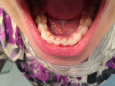 Niềng răng ở tuổi 28