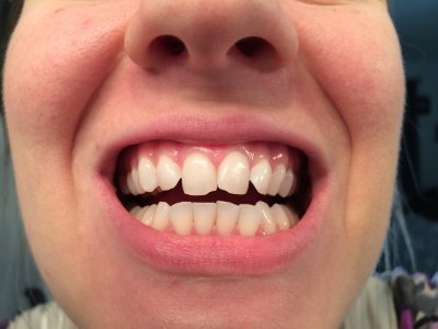 Niềng răng ở tuổi 28