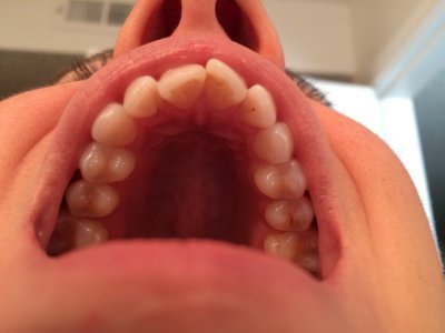 Niềng răng ở tuổi 28