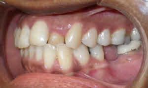 Trải nghiệm về quá trình niềng răng