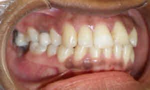 Trải nghiệm về quá trình niềng răng