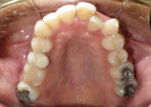 Trải nghiệm về quá trình niềng răng