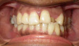 Trải nghiệm về quá trình niềng răng