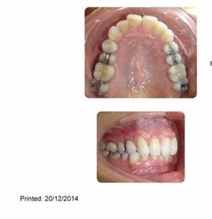 Niềng răng ở tuổi 50