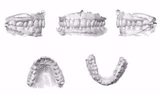 Niềng răng ở tuổi 50