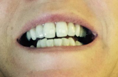 Niềng răng ở tuổi 50