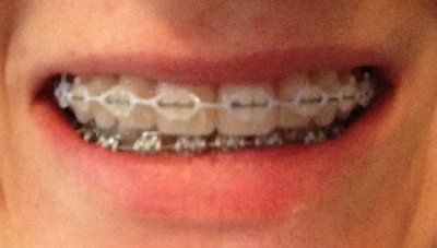 Niềng răng truyền thống để chữa răng khấp khểnh và một số tip