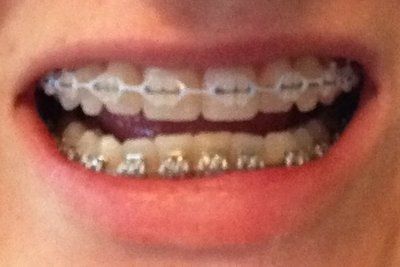 Niềng răng truyền thống để chữa răng khấp khểnh và một số tip