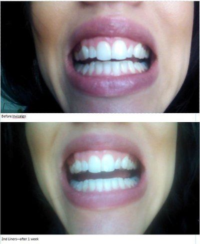 Trải nghiệm niềng răng Invisalign lần đầu