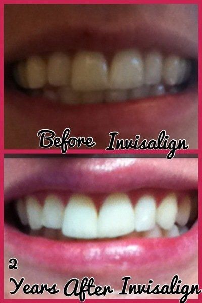 Niềng răng kim loại hiệu quả nhanh hơn và tốt hơn