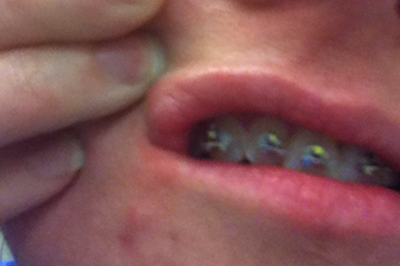 Niềng răng kim loại hiệu quả nhanh hơn và tốt hơn