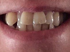 Nắn chỉnh răng bằng niềng Invisalign ở tuổi 53