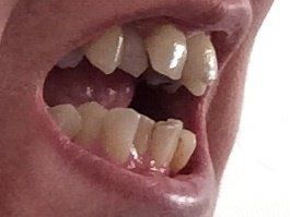 Nắn chỉnh răng bằng niềng Invisalign ở tuổi 53