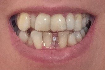 Nắn chỉnh răng bằng niềng Invisalign ở tuổi 53