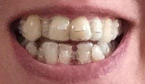 Nắn chỉnh răng bằng niềng Invisalign ở tuổi 53