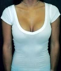 Hành trình nâng cấp vòng một từ size 34B lên size 34DD với túi độn 400cc độ nhô trên trung bình