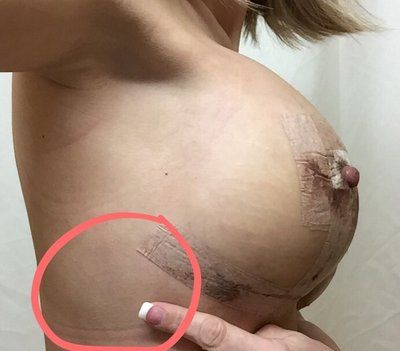 Nâng ngực chảy xệ kết hợp đặt túi độn ở cô gái có bộ ngực chảy xệ di truyền, 32 tuổi, cao 1m62, nặng 53kg