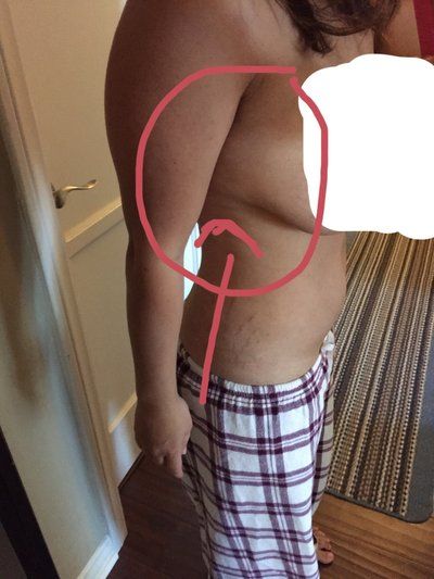 Mẹ 2 con với hành trình nâng ngực chảy xệ qua đường mổ dọc đứng hình cây kẹo kết hợp đặt túi gel silicon vỏ nhám, độ nhô cao, trên cơ.