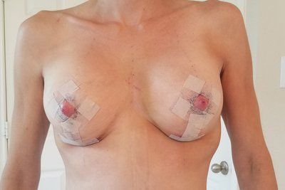 Hành trình 'trả lại" khe ngực đầy, cuốn hút với túi gel silicon Sentra, 350cc cho mẹ hai con 34 tuổi, 1m67, 52kg