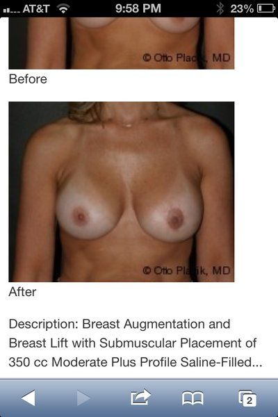 Hành trình từng bước lấy lại dáng ngực “thanh xuân” của bà mẹ 40 tuổi cao 1m65 nặng 60kg