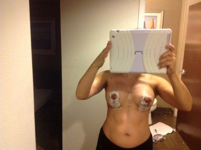 Nâng ngực chảy xệ qua đường mổ dọc đứng hình cây kẹo kết hợp đặt túi độn 325cc