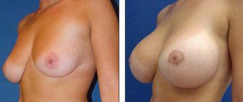 20 tuổi, nâng ngực chảy xệ kết hợp đặt túi gel silicon 475cc độ nhô cao, dưới cơ